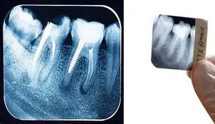 اشعة بري ابكل X-ray -Perapical