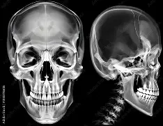 اشعة سينية لعظم الفك X-ray Mandible